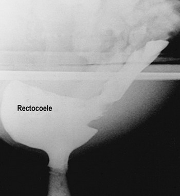 rectocoele